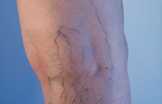 κιρσοί στα πόδια στις γυναίκες