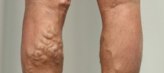 κιρσοί στο πόδι